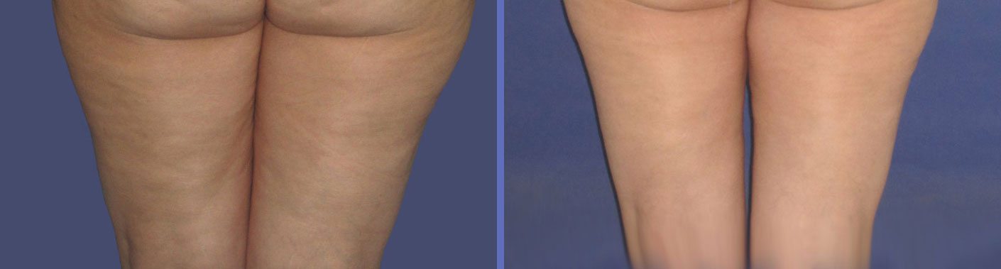 Resultado de imagen para Se puede eliminar la celulitis
