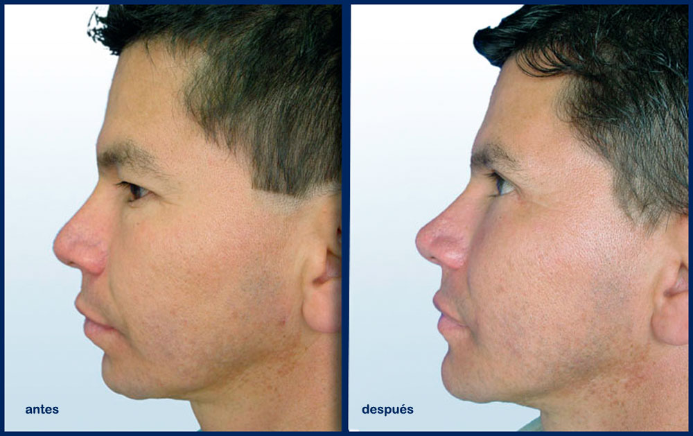 Cirugía de nariz en hombres