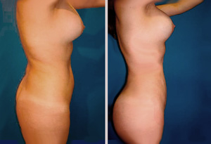 aumento-volumen-cola-300