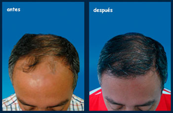Implante-Capilar-JGil-p